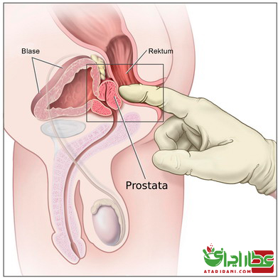 التهاب پروستات یا پروستاتیت 
