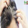درمان گیاهی موخوره، ریزش و سفیدی مو و انواع کاشت مو 