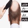 درمان قطعی ریزش مو تقویت موی سر با فرمول های گیاهی