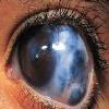 درمان گیاهی آب سیاه چشم در طب سنتی